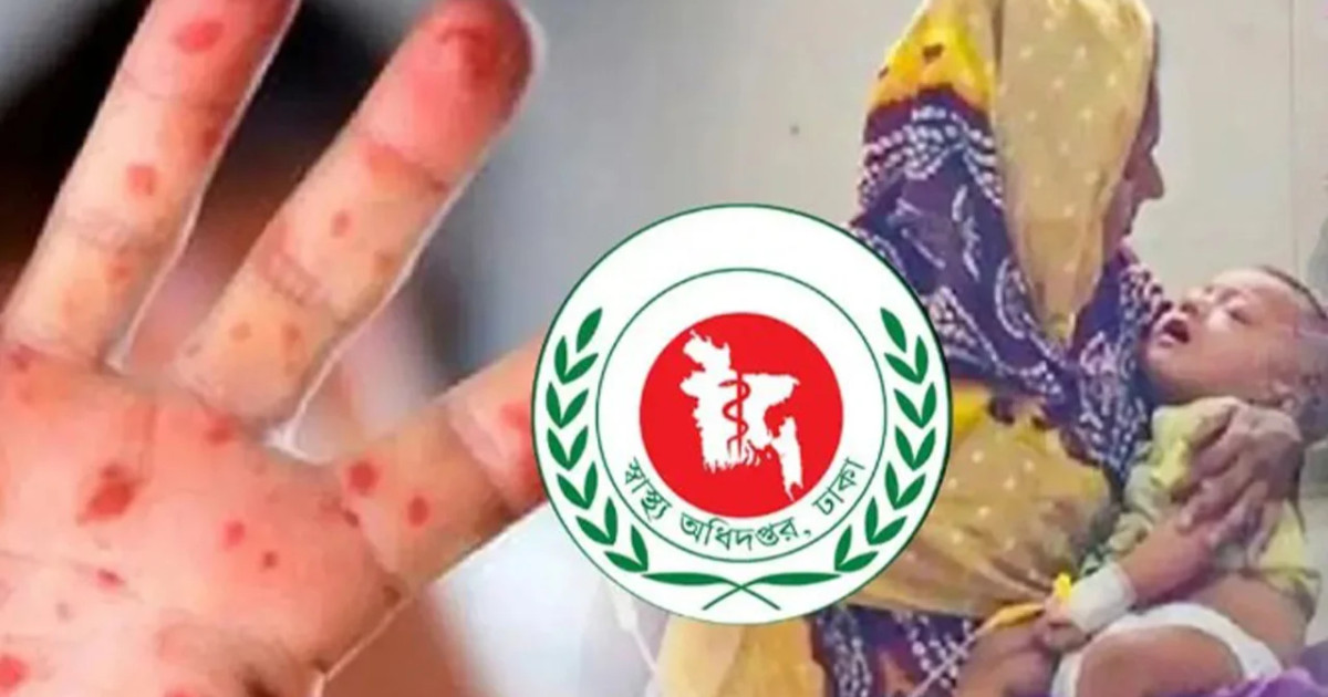 দেশে হাম পরিস্থিতি: ২৪ ঘণ্টায় ১১ জনের মৃত্যু, হাসপাতালে ভর্তি ১ হাজার ৩১৫
